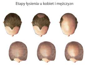 Etapy łysienia kobiet i mężczyzn